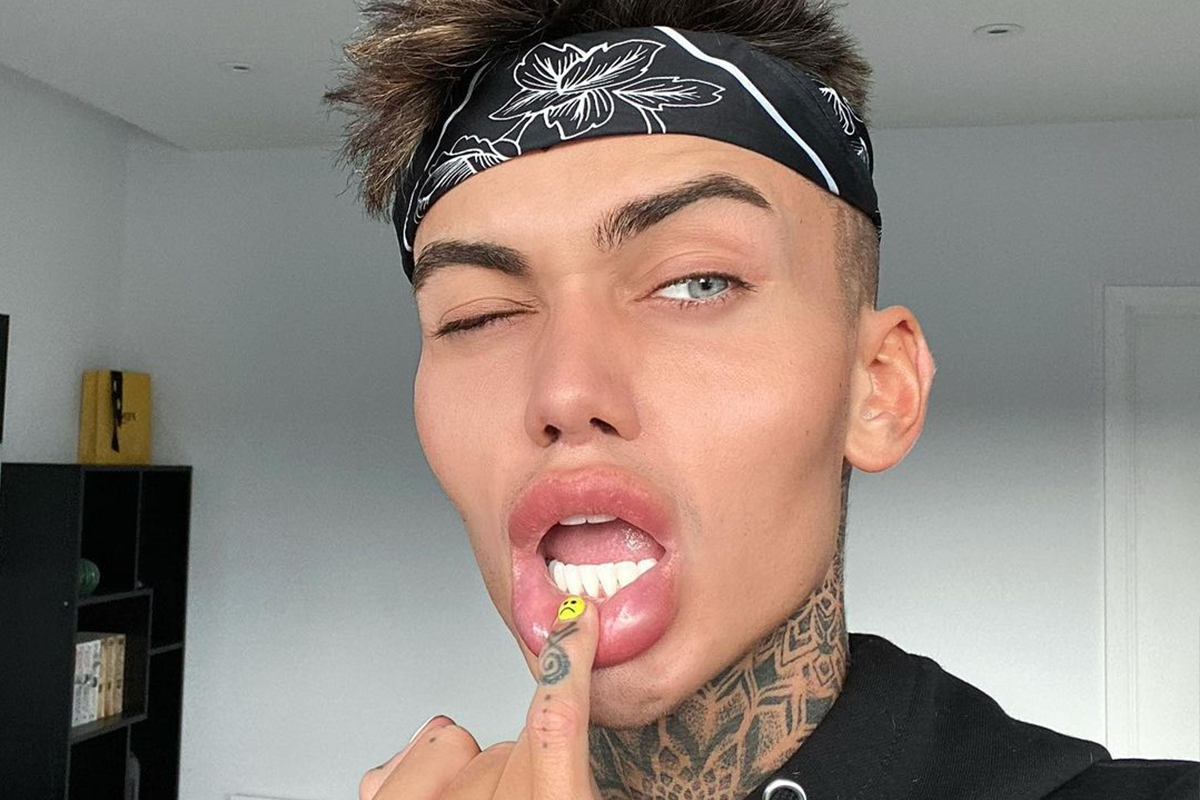 Mladík túži vyzerať ako instagramový filter. Za plastiky vysolil už viac ako 34-tisíc eur