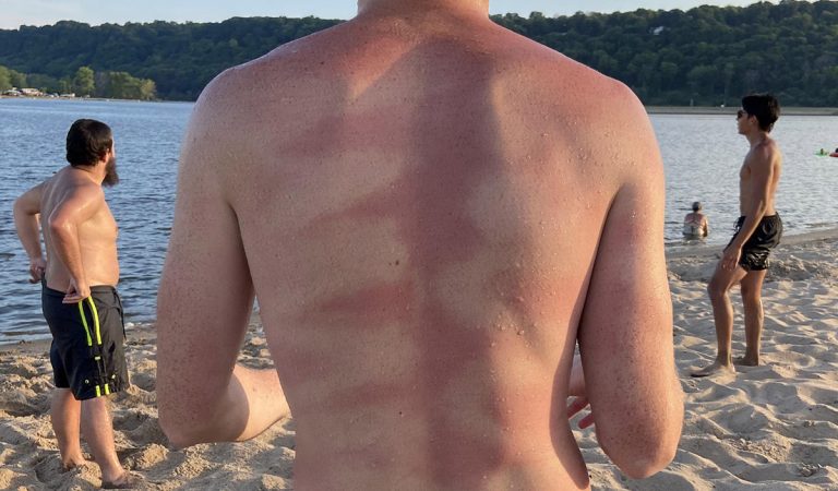16 ľudí, ktorí skončili so smiešnym opálením