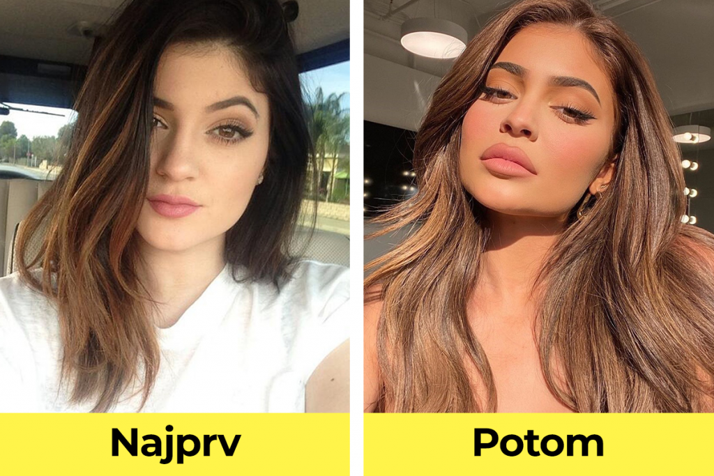 celebrity, známe osobnosti, plastická operácia, pred verzus po plastickej operácii, Kylie Jenner