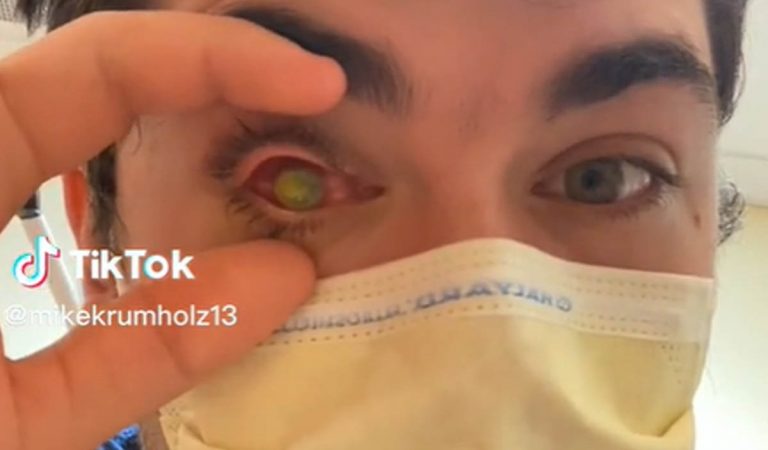 virál, TikTok, oko, parazitická infekcia, kontaktné šošovky