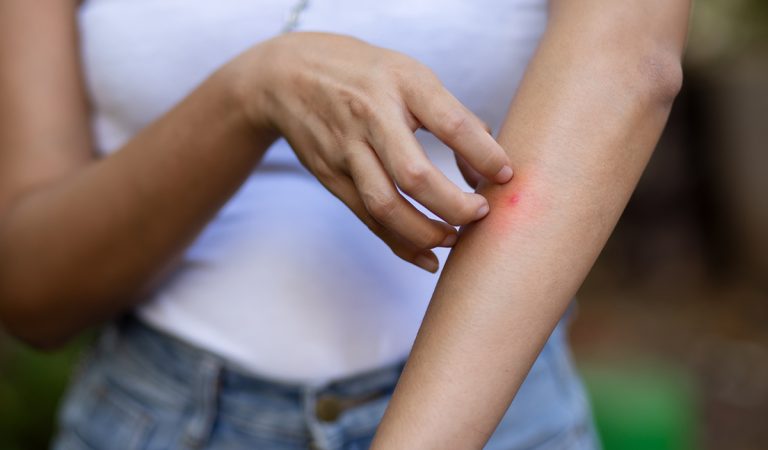 Máš pocit, že ťa komáre štípu viac ako ostatných? Vedci majú niekoľko vysvetlení