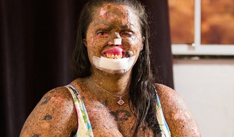Karine de Souza, Brazília, choroba, ochorenie, koža
