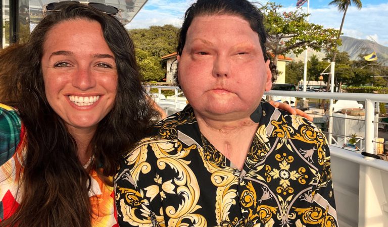 Cez internet sa zaľúbila do muža s transplantovanou tvárou. Žena tvrdí, že to bola láska na prvý pohľad