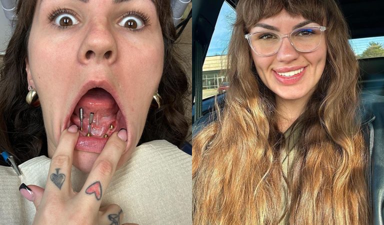Kvôli drogám prišla o zuby. Žena zaplatila za implantáty 37-tisíc, aby mohla opäť randiť