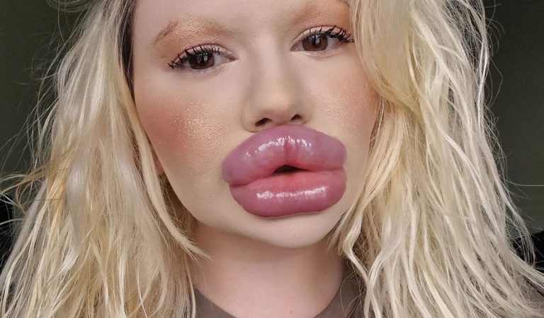 Žena s najväčšími perami sveta má problém. Musí si dať napichať nos, aby "nevyzerala staro"
