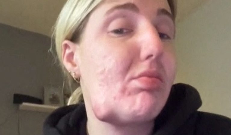Cysty ako pingpongové loptičky. Žena sa chcela zbaviť akné liekmi, dopadlo to katastrofou