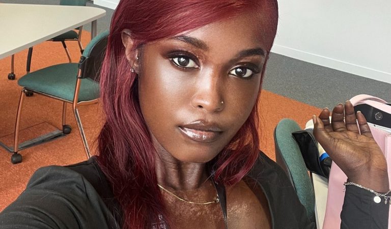 Influencerku obviňujú, že si bieli pokožku. Ľudia na internete jej neveria, že má vitiligo