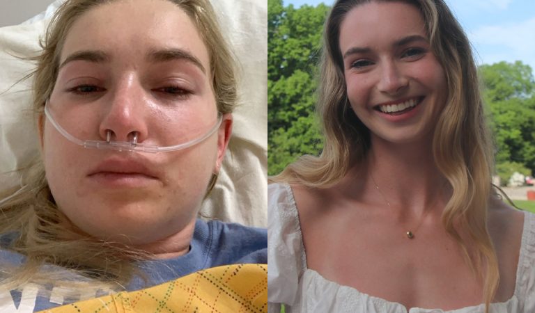 Môže jesť len dve potraviny, jeden bozk ju dokáže zabiť. Žena sa delí o strasti života s vzácnym ochorením