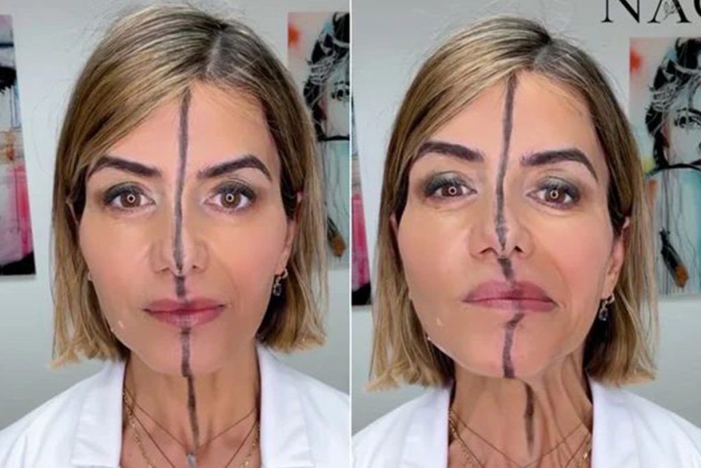 Doktorka predviedla, čo sa stane, keď si botox aplikuje do jednej polovice tváre. Výsledok natočila na video.
