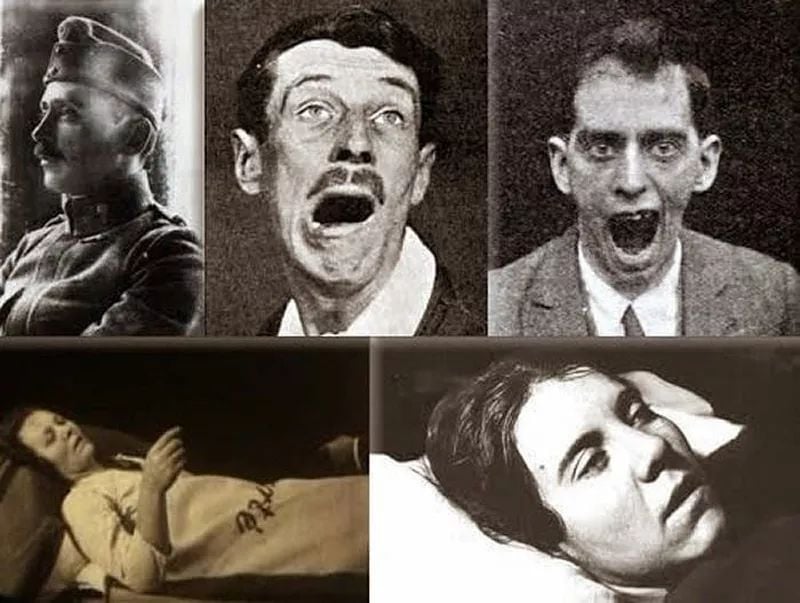 Epidémia letargickej encefalitídy vyčíňala pred sto rokmi. Dodnes zostáva záhadou, pretože jej pôvod sa nikdy nepodarilo rozlúštiť.