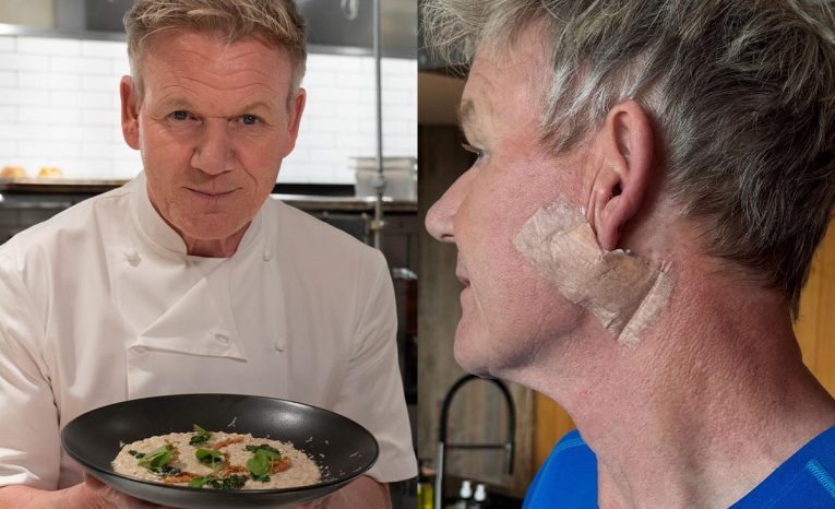 Gordon Ramsay karcinóm rakovina