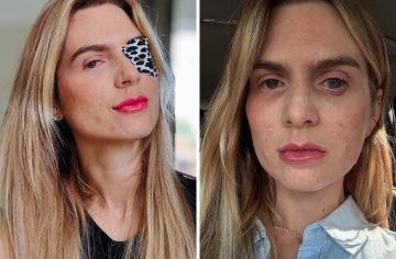 Najprv kóma, potom strata zraku. Liek, ktorý má doma každý Slovák, spôsobil žene vážne zdravotné problémy