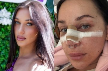 Bianka Rumanová napokon ukázala, ako vyzerá jej nový nos. Zmena je obrovská