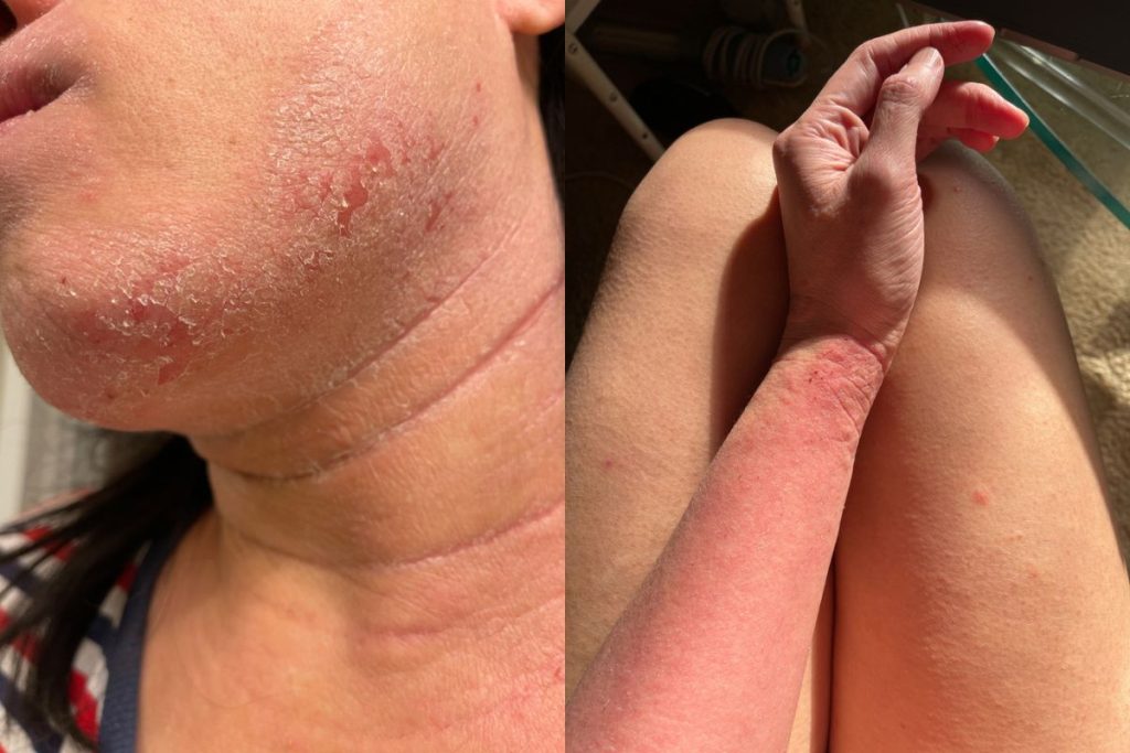 Lekári im neveria, oni prežívajú peklo: Ľudí trápi záhadný syndróm, pri ktorom sa im odlupuje koža