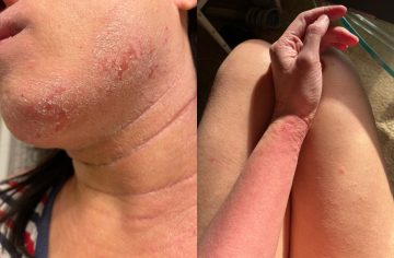 Lekári im neveria, oni prežívajú peklo: Ľudí trápi záhadný syndróm, pri ktorom sa im odlupuje koža