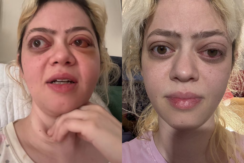 Žena trpela vážnou chorobou lekári si ju pomýlili s alergiou