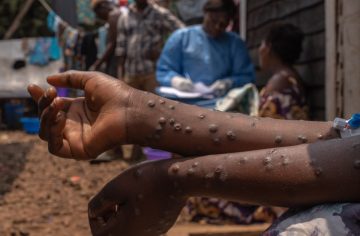 Choroba, ktorá desila svet, je už aj u nás. V Bratislave pribudli nové prípady, toto o nej musíš vedieť