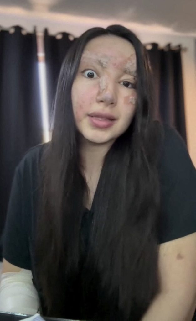 Influencerka so zohavenou tvárou varuje ľudí pred veľkou chybou