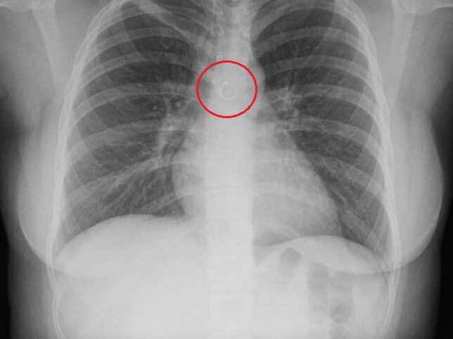 Monica Deyanira Cabrera Barajas piercing pľúca