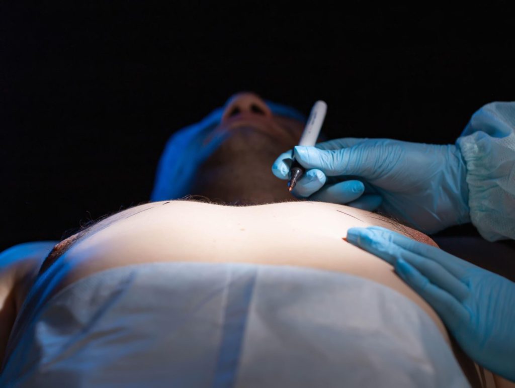 Zákroky kozmetickej chirurgie medzi mužmi v USA majú nečakané lídra - najrozšírenejšou operáciou je redukcia pŕs.