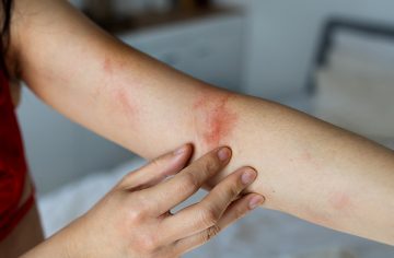 Predtým trápila kone a kravy, dnes ľudí: V Európe hlásia prípady nepríjemnej baktérie, pozor na tieto 4 príznaky
