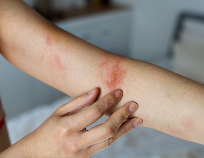 Predtým trápila kone a kravy, dnes ľudí: V Európe hlásia prípady nepríjemnej baktérie, pozor na tieto 4 príznaky