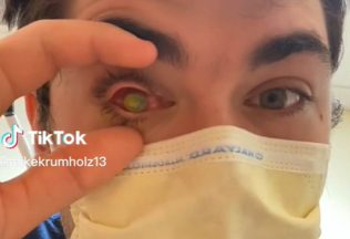 virál, TikTok, oko, parazitická infekcia, kontaktné šošovky