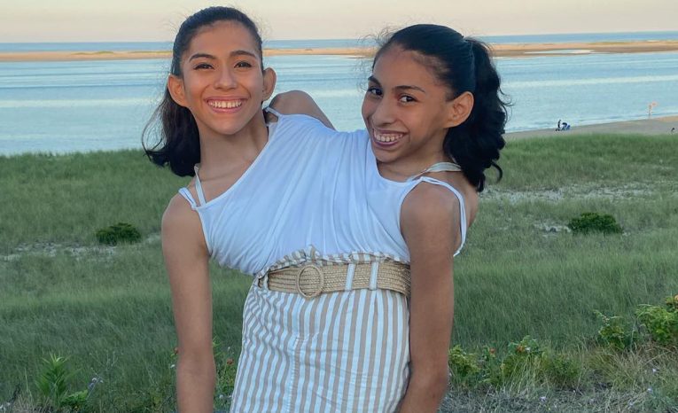 Lupita a Carmen Andrade, siamské dvojčatá, zrastené dvojčatá