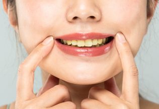 Aké potraviny zafarbujú zuby a ako proti žltým zubom bojovať? Tu je odpoveď