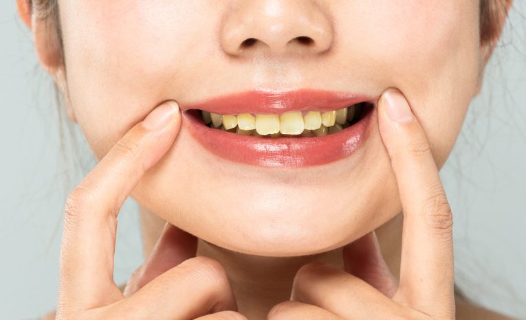 Aké potraviny zafarbujú zuby a ako proti žltým zubom bojovať? Tu je odpoveď