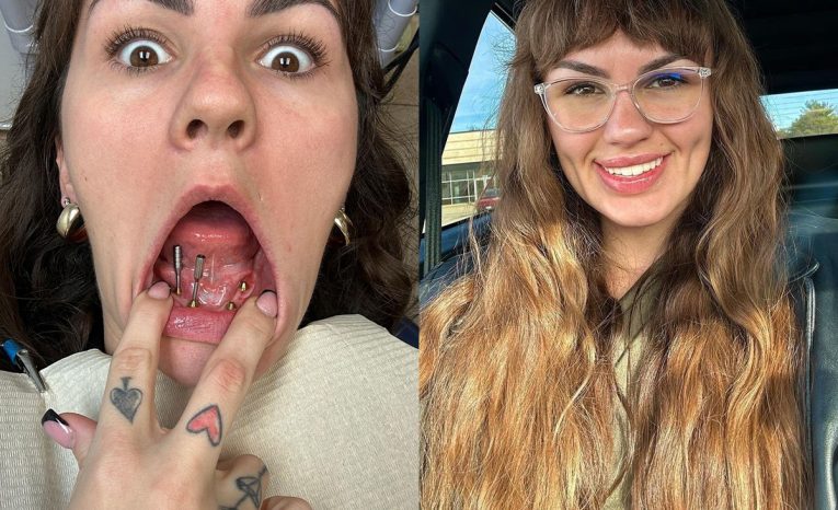Kvôli drogám prišla o zuby. Žena zaplatila za implantáty 37-tisíc, aby mohla opäť randiť