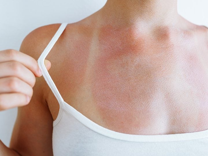Slovenka o živote s alergiou na slnko: Kamaráti ma prezývajú upírka, letá sú neuveriteľne únavné (ROZHOVOR)